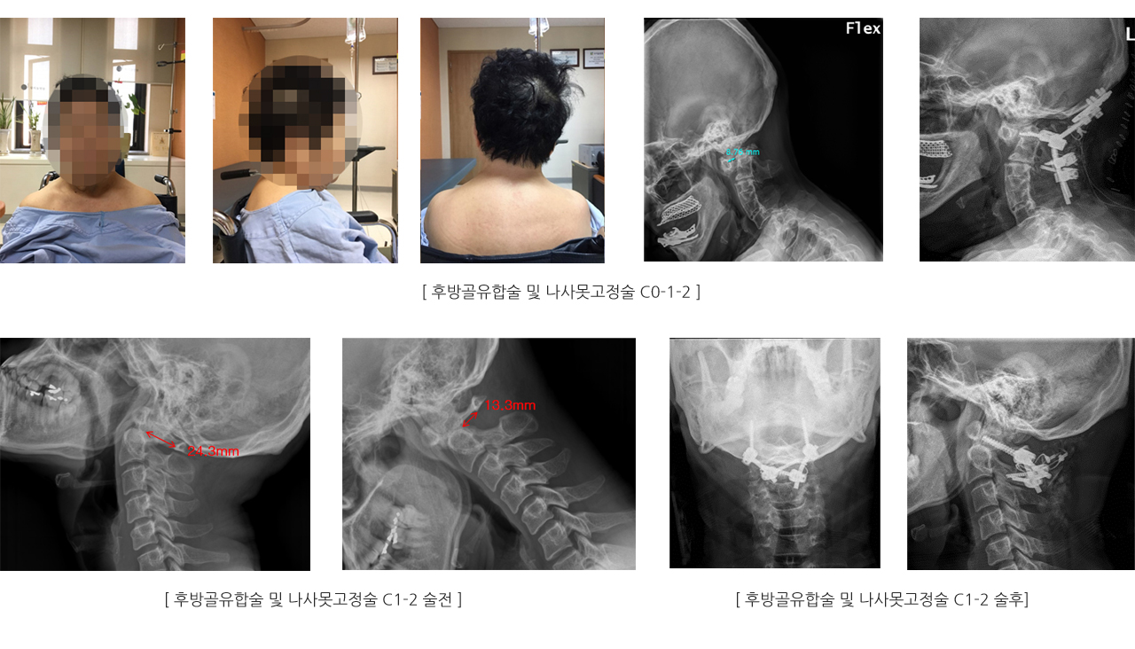 상부 경추 수술